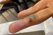 小琉球遊客遭海膽刺傷！「10幾根黑刺」插手指　慘變蜂窩性組織炎