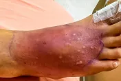 非老年人專屬！天熱「蜂窩性組織炎」病人增加　醫驚：熱浪會促進炎症