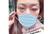 不只名牌包被偷！佩甄旅遊大過敏　眼皮突「腫到變形」慘況曝光