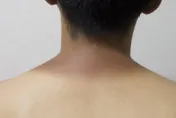 皮膚黑黑粗粗「像沒洗乾淨」！恐是糖尿病徵兆　嚴重還會有異味