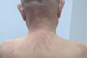 睡醒驚見「被鞭打」痕跡！陸人夫就醫才知「香菇惹禍」