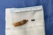8歲妹被鉛筆刺傷竟慢性骨髓炎　醫開刀驚：筆芯還嵌在腳裡