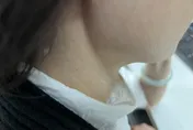 心臟衰竭比癌症更致命！醫揭「頸部靜脈浮起」是重要警訊