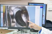 8歲女童「吞毛髮」腹痛嘔吐　醫傻眼：胃部和小腸裡都是