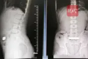 影/金價狂飆...11歲蘇州童「百克金條一口吞」　爸媽傻眼急送醫