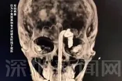 影/嚇！陸男酒後摔倒鐵支插入口　「直穿顱內」驚悚畫面曝