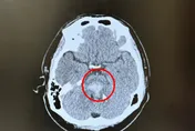 新竹38歲男腦幹出血全癱！半年顱磁刺激術治療　已能行走