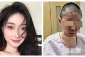 父親一根菸引爆炸！女網紅家毀人傷　「臉被燒爛」拍片自救籌200萬