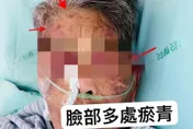 影/台中嬤莫名「瘀青」滿身傷　家屬驚見看護揮打氣炸