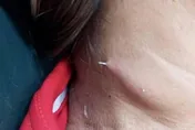 悚！泰女誤吞魚刺卡喉嚨　2週後竟「穿透皮膚」冒出