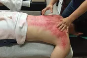 中暑如何刮痧自救？中醫教「出痧手法」助快速退熱
