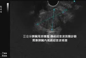 「胰臟癌」潛伏太兇！　醫示警：3種症狀別輕忽
