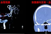 突然肢體無力、講話大舌頭？醫示警：黃種人易血管狹窄