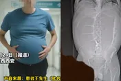 影/滿肚子大便！陸大叔動手術卸載「10分鐘狂排20公斤」