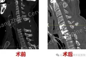 奇蹟！陸民眾遭機械手臂重擊頸部「身首分離」　醫師巧手接回
