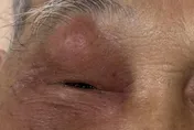 84歲翁「急性鼻竇炎」害眼睛腫脹！醫：嚴重恐致腦膜炎