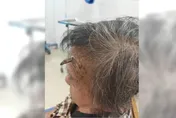 頭長「犄角」拿剪刀喀嚓...98歲上海嬤險大出血丟老命