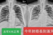 每年照X光都正常　男子竟驗出滿天星肺癌末期