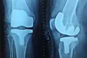 補鈣就能顧骨頭？專家：像蓋房子只有磚頭沒水泥和工人