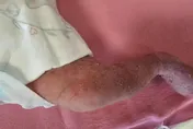 4萬分之1機率！新生女嬰全身紅疹　確診罕見色素失調症