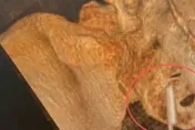 溫度計插屁股！女時隔22年才取出　醫：差點汞中毒