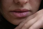 起床見「嘴唇上有白膜」纏身一週　醫：恐非小事快就醫