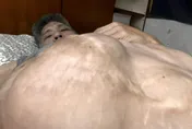健康堪憂…連體嬰弟弟忠義「嚴重腹脹照曝光」　PO文喊：不會放棄
