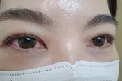 眼睛紅腫恐是「急性結膜炎」醫：共用眼藥水易群聚感染