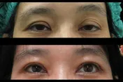 47歲女困擾10年眼瞼下垂　「提眼矯正術」變身美魔女