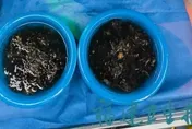胃痛3年竟是它惹禍！陸10歲女童胃中驚取「兩大盆頭髮」