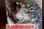 6旬婦「乳頭濕疹」3個月未癒…竟確診罕見乳癌第二期