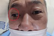 50歲男午睡醒來「右眼無法轉動」！以為中暑竟是腦中風