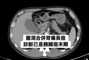 50歲後才得糖尿病要小心！醫：胰臟癌風險是一般人8倍