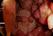 大腸內數百顆瘜肉竟是「致命遺傳」　醫：不治療百分百癌化