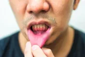 常嘴破小心一病！陸男以為火氣大未重視　反復口腔潰瘍後竟致失明