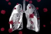母死於肺癌！篩檢揪「芝麻大腫瘤」　男嘆：颱風天重生了