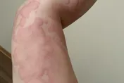 只是皮膚過敏？慢性蕁麻疹讓她三度急診　呼吸困難險喪命