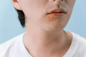 唇疱疹病毒不只傷口腔！專家：恐攻擊大腦增失智風險