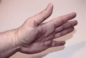 手指「喀」一聲才能動？中醫針灸可有效改善扳機指症狀