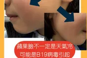 「蘋果病」悄悄回歸！醫師一天遇2例　曝：像被打兩巴掌