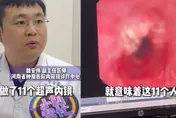 河南醫院一上午「11人確診食道癌晚期」　醫痛心：恐活不過5年