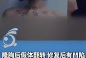 陸女砸17萬隆胸「一翻身就塌」　院方稱可能「尺寸太小」