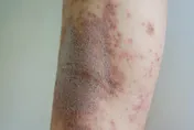 梅毒感染者多無症狀延遲就醫！醫：交友軟體增暴露機會