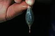 信偏方治頭痛！陸婦生吞魚膽引肝衰竭　醫生示警：比砒霜還毒