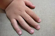 7歲異膚童狂咬指甲講不聽！醫：補鋅、B群比禁止更有效