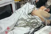 陸女看牙醫被一口氣「拔12顆牙」！下巴脫臼「合不攏」心梗命危