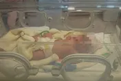 疑遭長女傳染腸病毒！孕婦發燒急剖腹產女　胎兒出生6天後亡