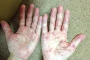 今年首例！10多歲男童手腳無力「竟是腸病毒重症」