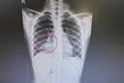 A流好了還在咳！9歲童咳到肋骨痛又高燒…竟是黴漿菌