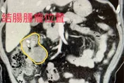 6旬翁愛吃「高油鹽食品」頭暈、易喘　竟是大腸癌三期